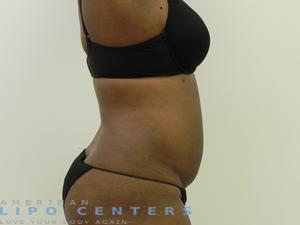 americanlipocenters_52.jpg